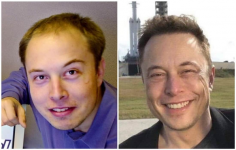 elon-musk-before-after-hair-transplant-result-1.png