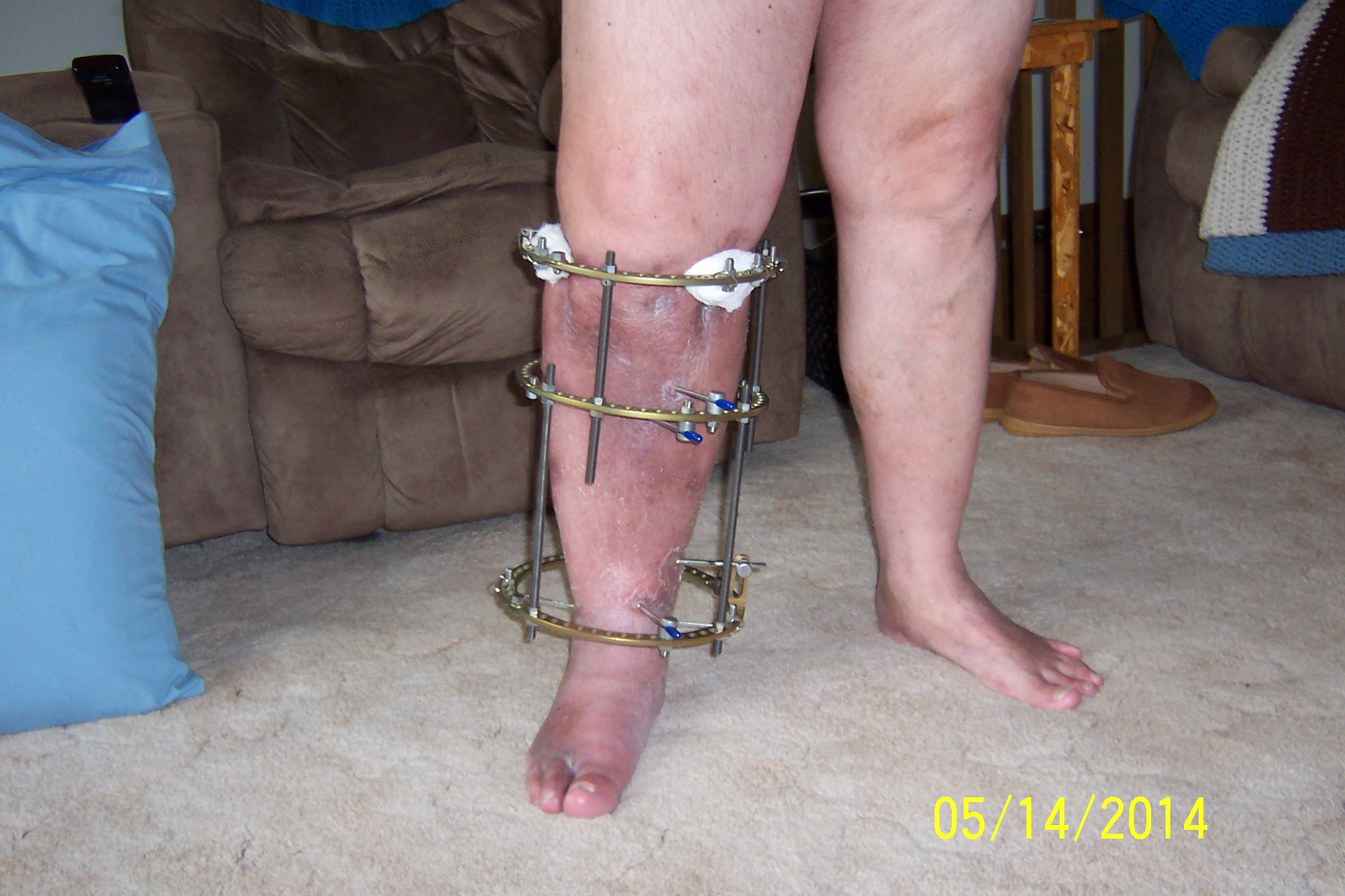 2013 Broken Leg Pic's 022.JPG