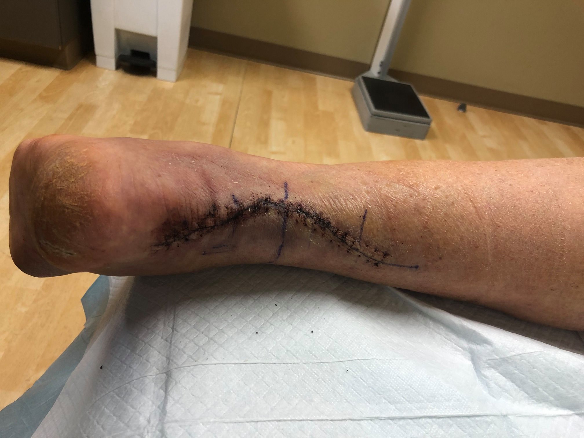 Achilles OUCH.jpg