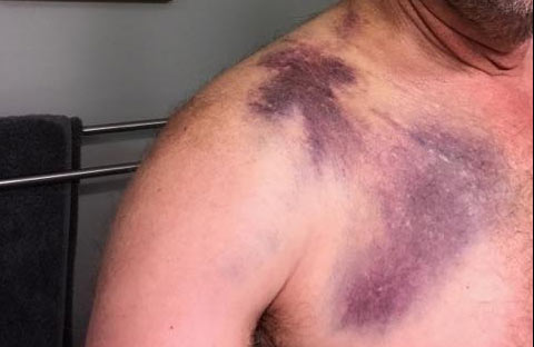 collarbone-bruise.jpg