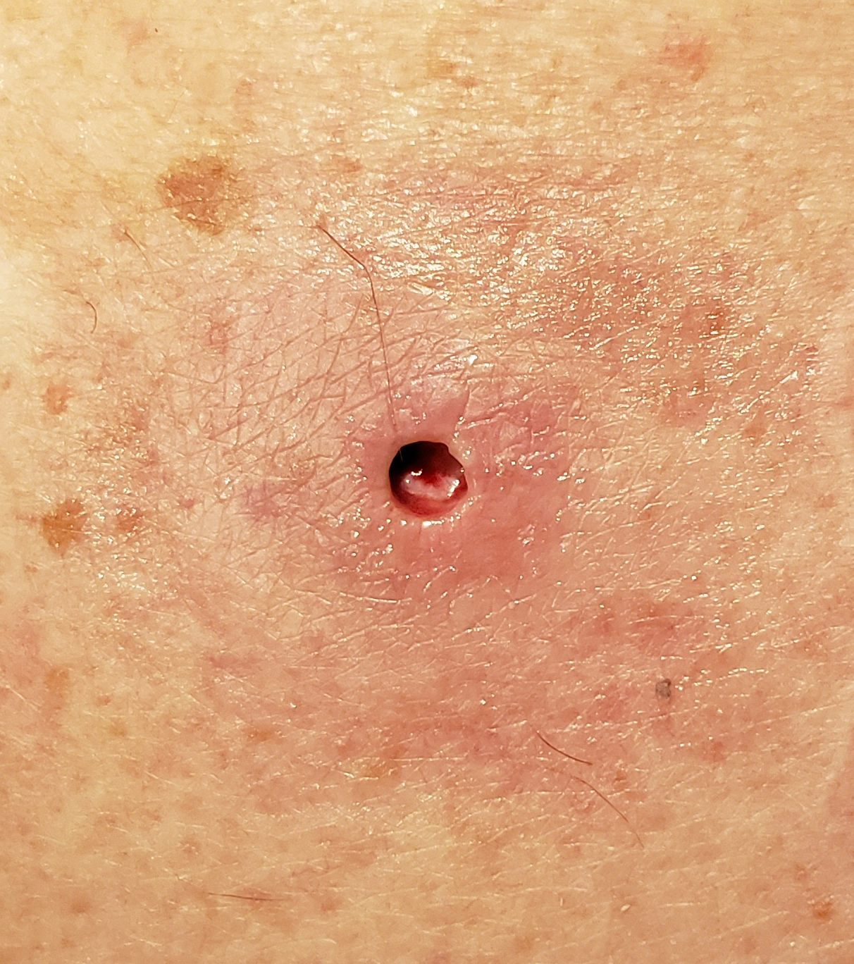 cyst1.jpg