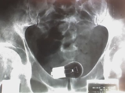 How-to-Remove-an-Electric-Bulb-from-Rectum-2.jpg