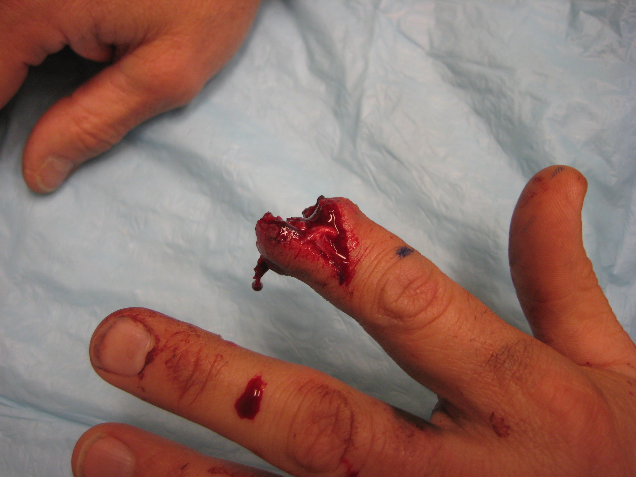 meyette finger amputation gsw 002.jpg