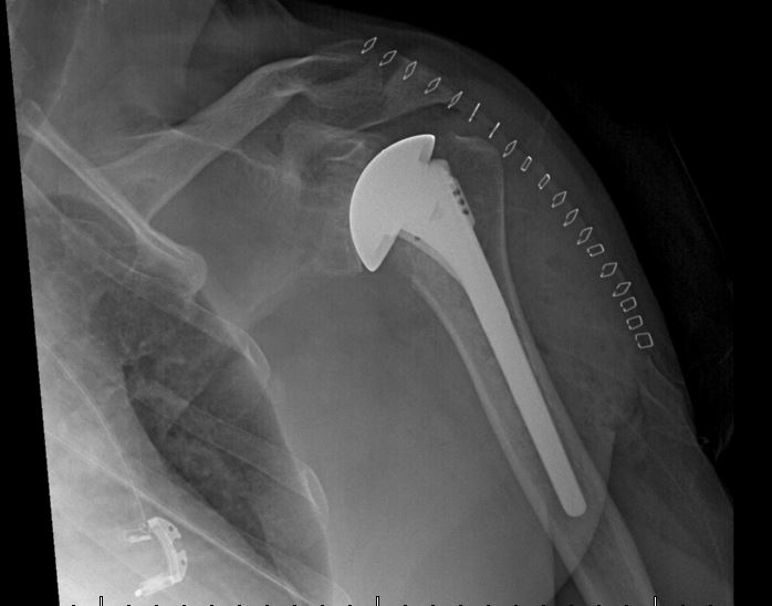 new shoulder.JPG