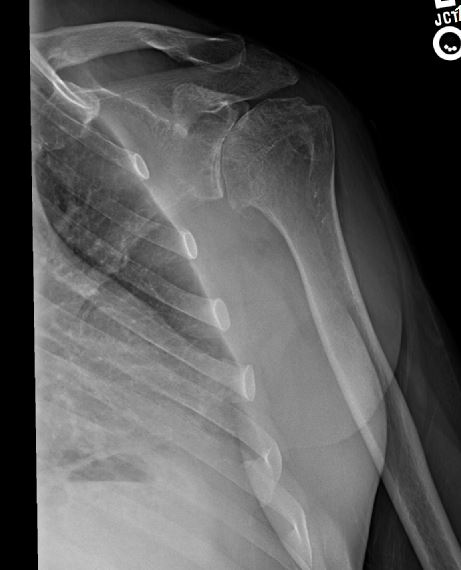 old shoulder.JPG