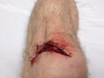 Saw Wound1.JPG