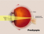 Presbyopia.gif